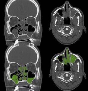 3D Кт Придаткових Пазух Носа Київ Осокорки Док Лайф