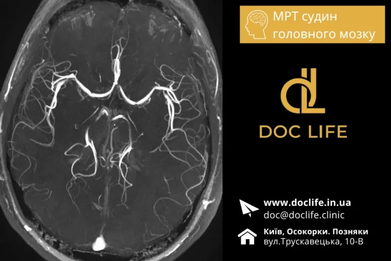 Обстеження Судин Головного Мозку Методом Мрт В Осокорках Мр Ангіографія Київ