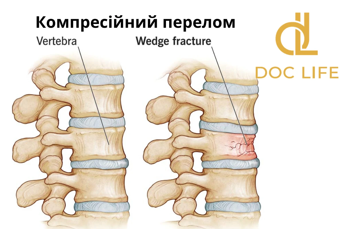 Травми Хребта -  Компресійний Перелом Хребта.