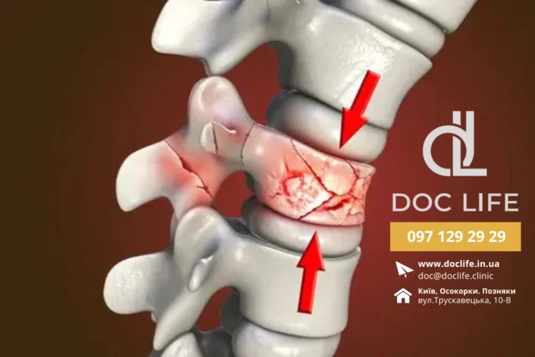Травми Хребта – Компресійний Перелом Хребта