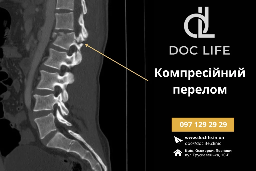 Травми Хребта -  Компресійний Перелом Хребта.