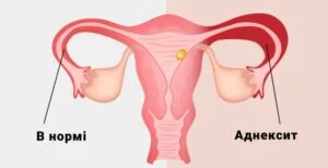 Аднексит Запалення Придатків Матки