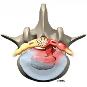 Грижа Міжхребцевого Диска