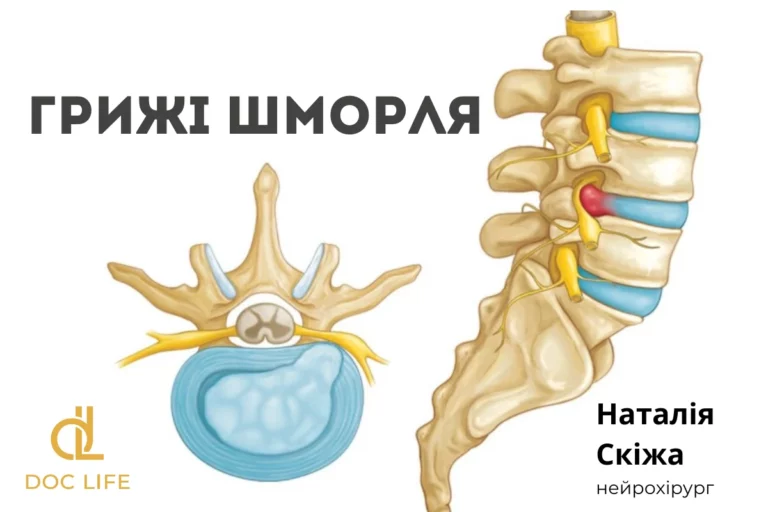 Грижа Шморля На Мрт Хребта Скіжа Наталія Нейрохірург Київ Позняки Осокорки 6