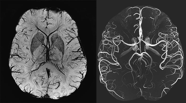 Mrt Angiografiya