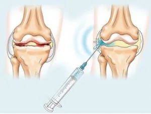 Ін'Єкції Гіалуронової Кислоти - Внутрішньосуглобові Ін'Єкції