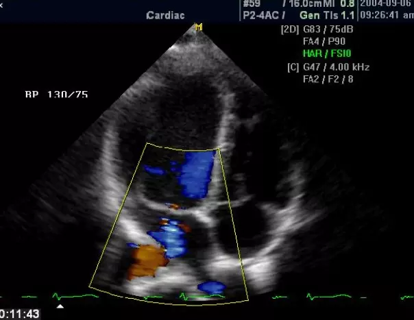 Ехокардіографія В Києві На Позняках: Діагностика Серця