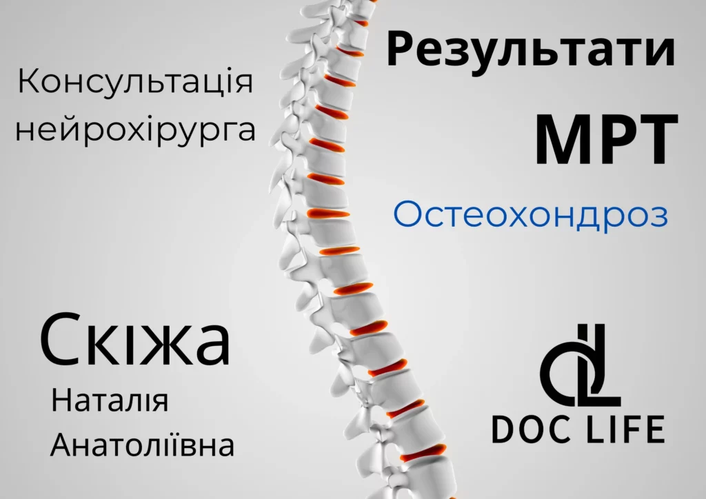 Результати Мрт Екструзія Міжхребцевого Диска L5-S1, Протрузія Міжхребцевого Диска L2-L3 Остеохондроз І Спондилоартроз Поперекового Відділу Хребта Київ