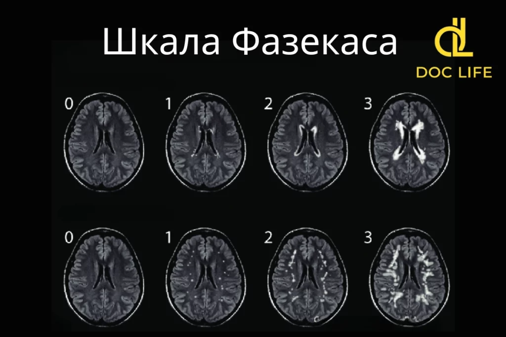 Шкала Fazekas: Що Означають Результати Fazekas 1 Та Fazekas 2?