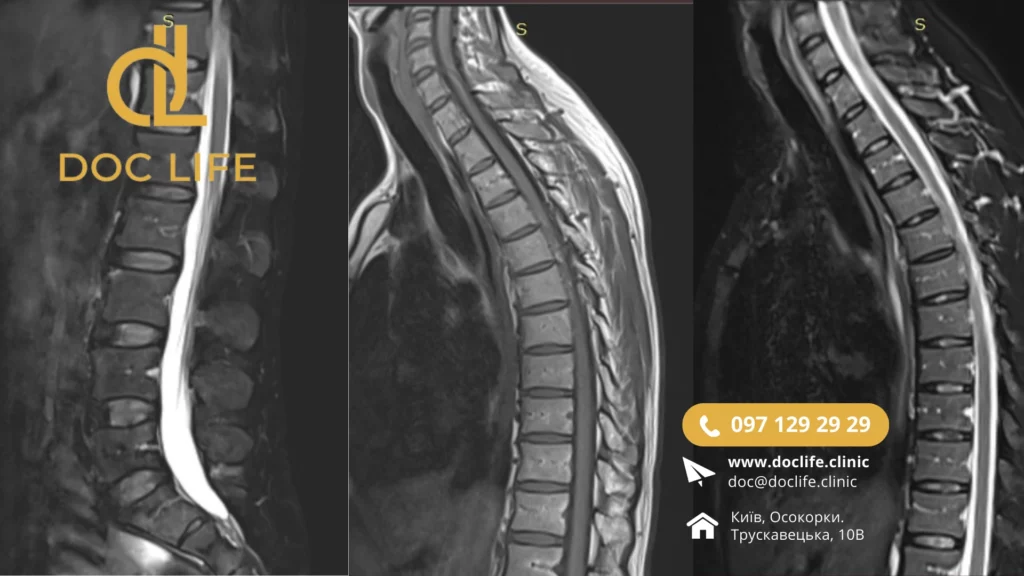 Остеохондроз Діагностика За Допомогою Мрт Шийного, Грудного Та Поперекового Відділів Хребта