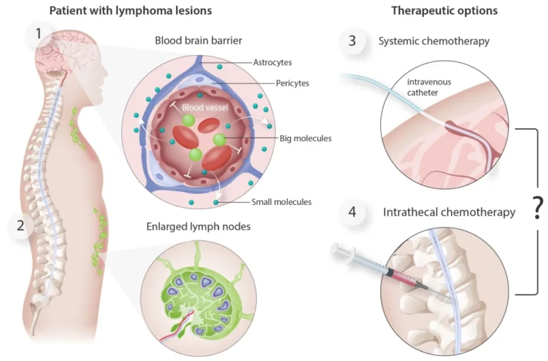 B-Cell Large Cell Lymphoma Нові Підходи До Запобігання Поширенню На Центральну Нервову Систему При Дифузній Великоклітинній B-Клітинній Лімфомі