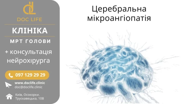 Церебральна Мікроангіопатія Діагностики Та Лікування В Києві Скіжа Наталія Нейрохірургія Києва