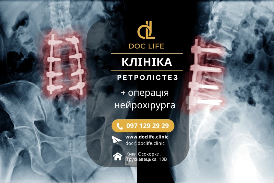 Ретролістез L5 Операція - Хірургічне Лікування Нейрохірург Скіжа Наталія Анатоліївна Київ Осокорки