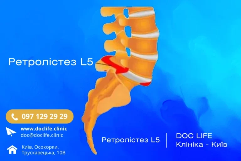 Ретролістез L5 Візуалізація На Мрт Хребта Клініка Док Лайф Позняки Осокорки