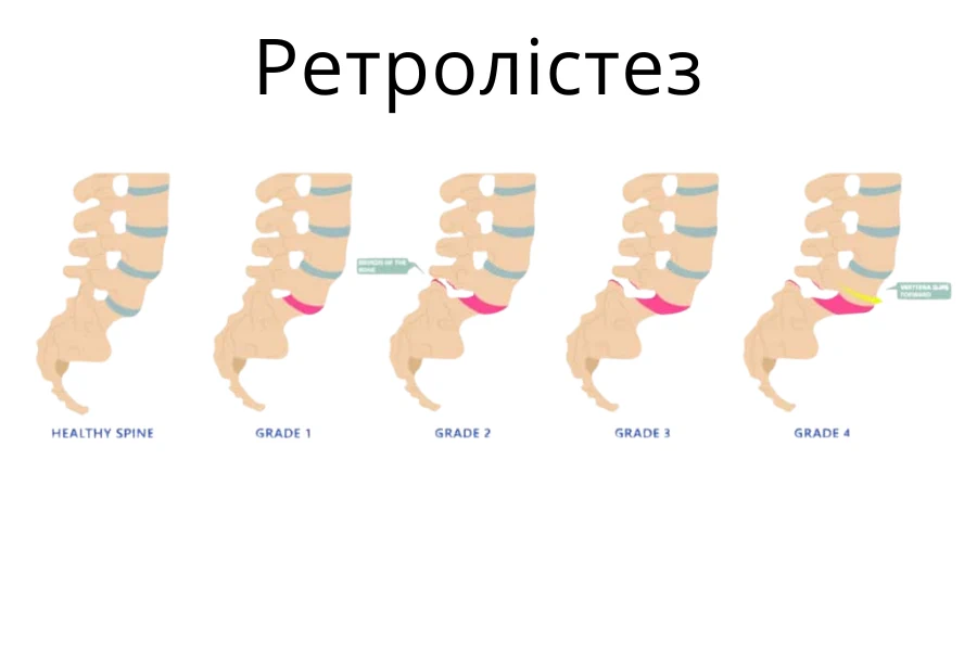 Symptomy Retrolistezu L5 Opys I Vizualizacziya Klinika Dok Lajf Poznyaky Osokorky