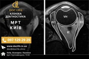 Магнітно-Резонансна Томографія Очей Та Орбіт На Позняках У Doclife