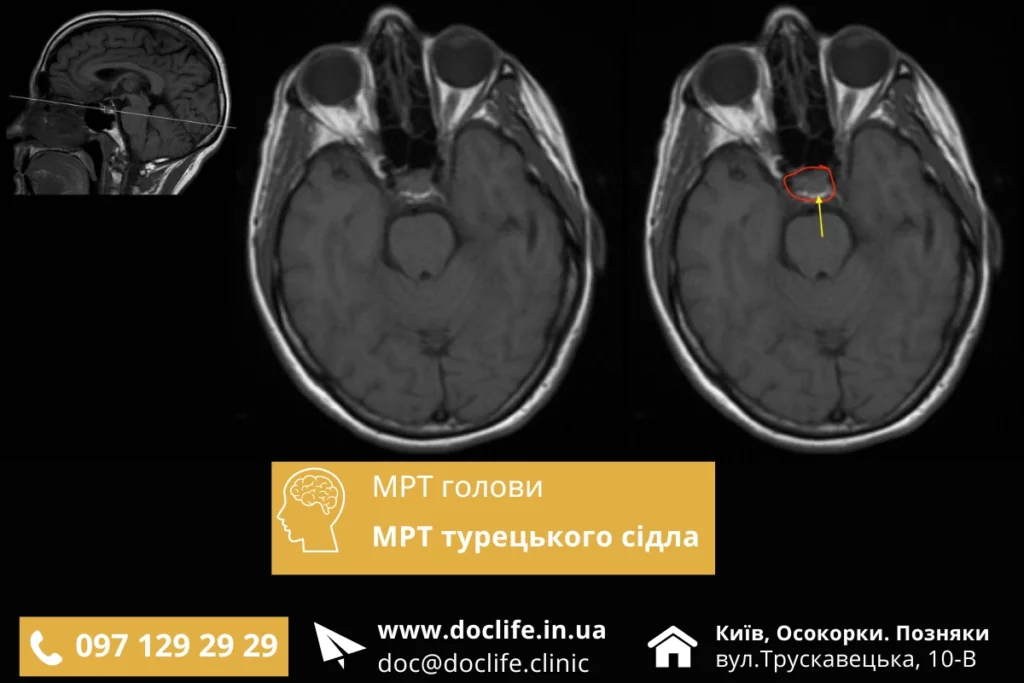 Мрт Турецького Сідла Без Контрасту — Сучасне Обстеження В Києві.