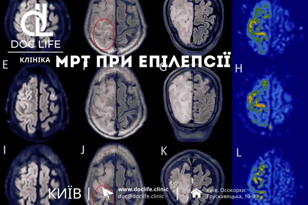 Мрт При Судомних Станах: Як Виявити Причину Нападів І Виключити Епілепсію