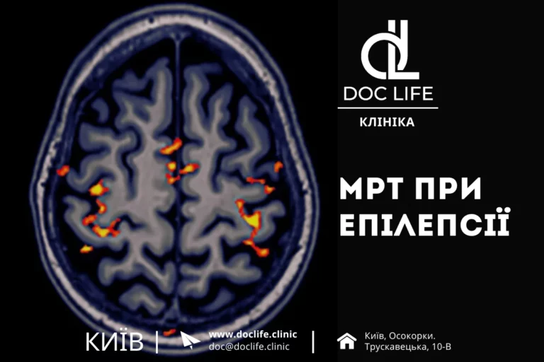 Мрт Головного Мозку При Епілепсії Мрт При Епілепсії Київ Осокорки Doc Life 5