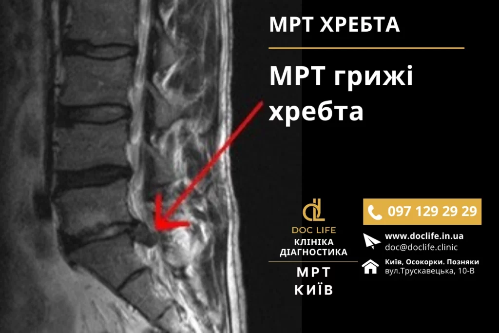 Мрт При Остеохондрозі Шийного Відділу Хребта