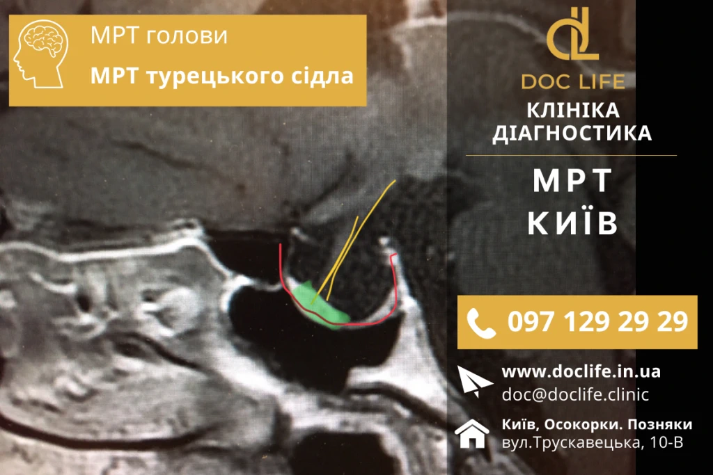 Мрт Київ Магнітно-Резонансна Томографія Турецького Сідла Мрт Турецького Сідла Київ Діагностика Позняки Осокорки 2024