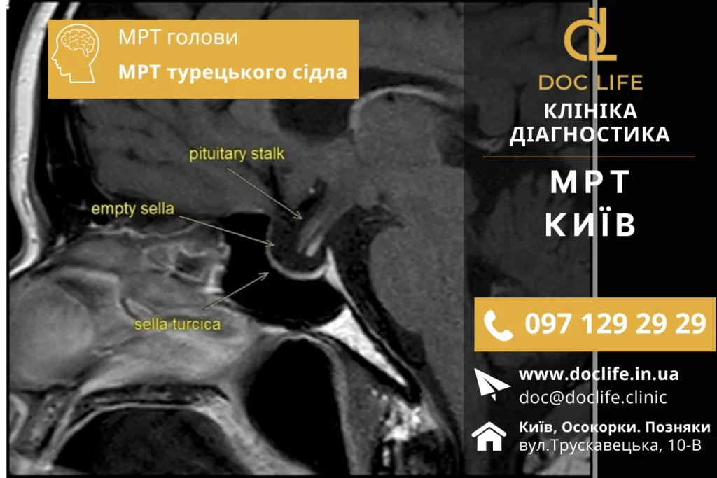 Мрт Турецького Сідла В Києві — Діагностика Гіпофізарних Патологій У Doclife