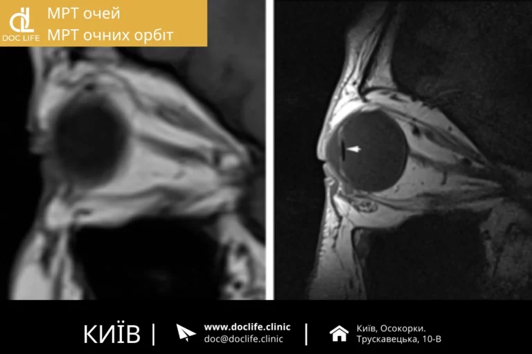 Мрт Очей, Орбіт Та Очних Ямок Київ Осокорки Doc Life 1