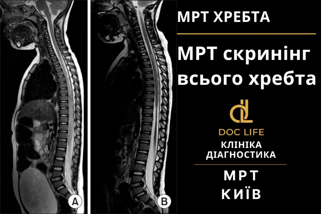 Мрт Скринінг Хребта Київ, Мрт Скринінг Всього Хребта Мрт Хребта Київ Позянки Осокорки Мрт Всього Хребта