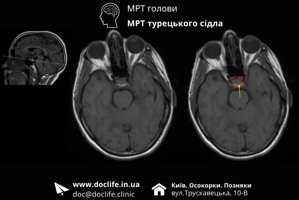 Поодинокі Неспецифічні Вогнищеві Зміни Паренхіми Головного Мозку На Мрт Голови З Судинами