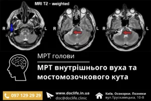 Мрт Внутрішнього Вуха Та Мостомозочкового Кута Київ Діагностика Та Ціна Мрт