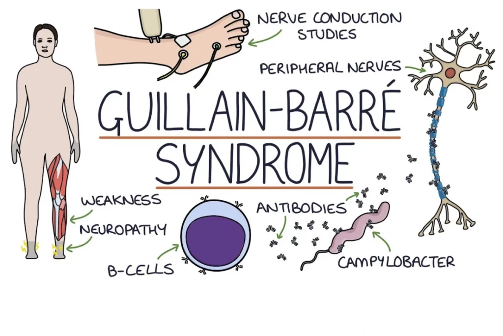 Синдром Гійєна-Барре Київ Діагноз Мрт Та Енмг 2024