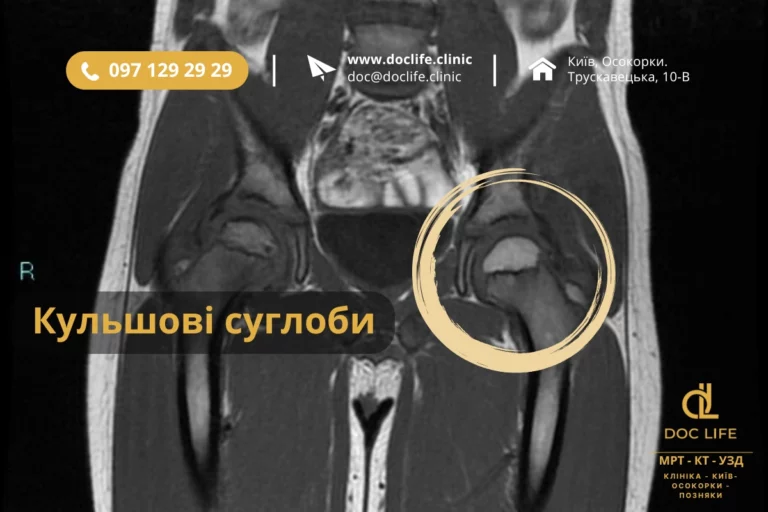 Кульщові Суглоби Результати Обстеження Мрт Кульщові Суглоби