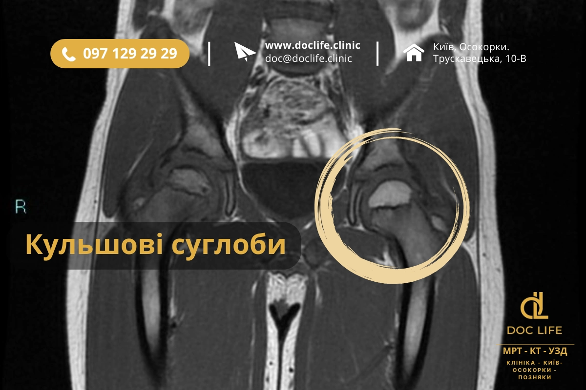 Кульщові Суглоби Результати Обстеження Мрт Кульщові Суглоби