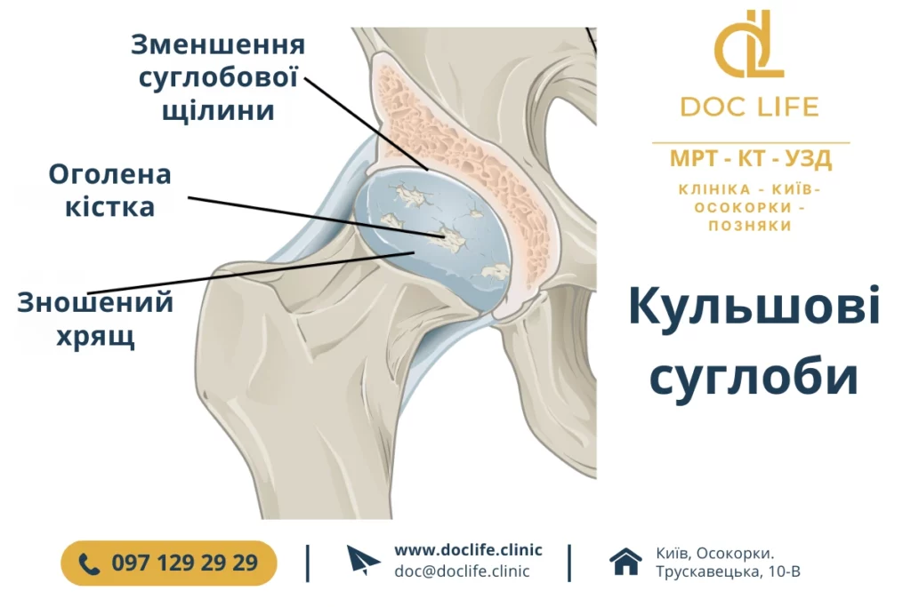 Кульщові Суглоби 5 Коксартроз Кульшових Суглобів: Клінічний Аналіз Діагнозу Та Роз'яснення Мрт