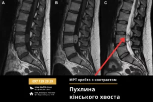 Пухлини Кінського Хвоста Проблематика Методи Діагностики Та Лікування Київ Осокорки