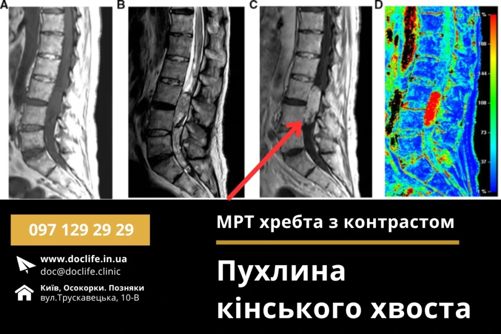 Пухлини Кінського Хвоста Проблематика Методи Діагностики Та Лікування Мрт Хребта З Контрастом Київ