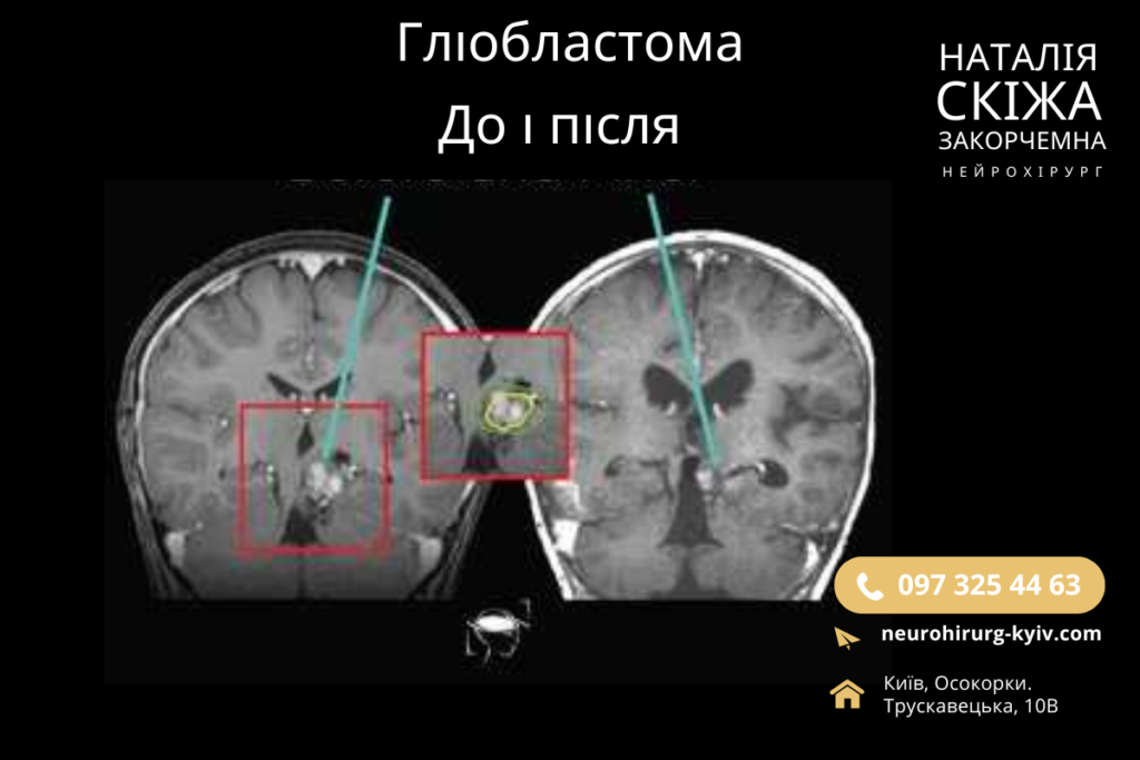 Перспективний Підхід До Лікування Гліобластоми