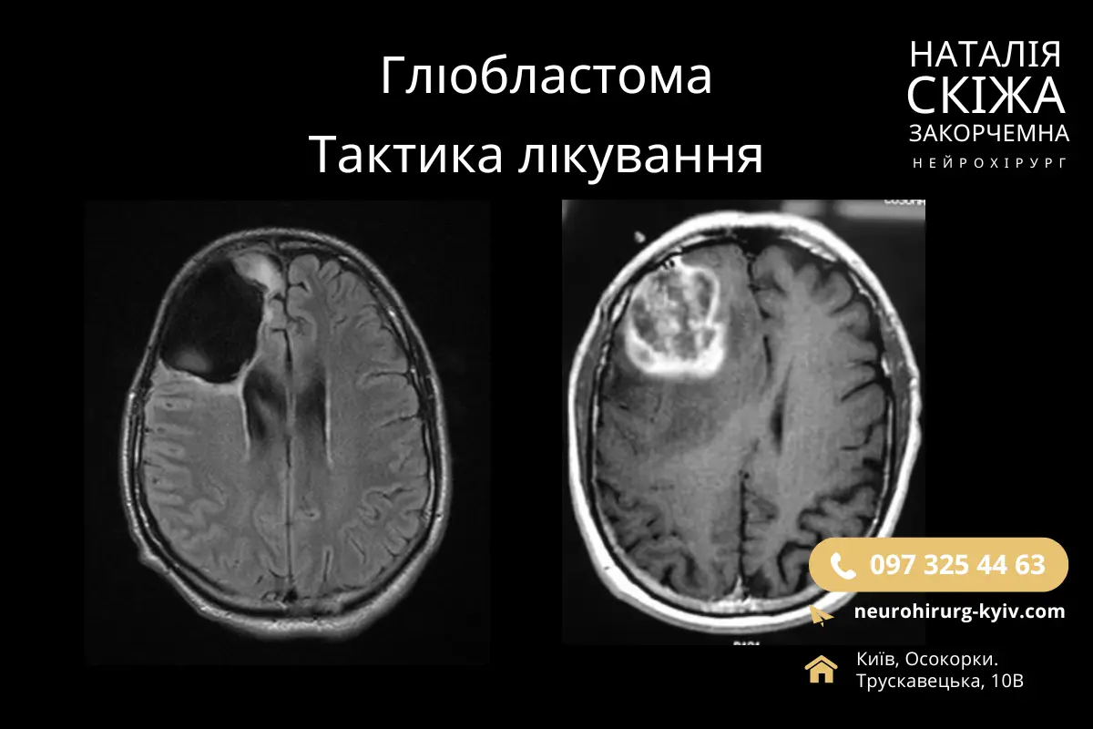 Тактика Лікування Гліобластома Головного Мозку Лікар Нейрохірург Наталія Скіжа Київ