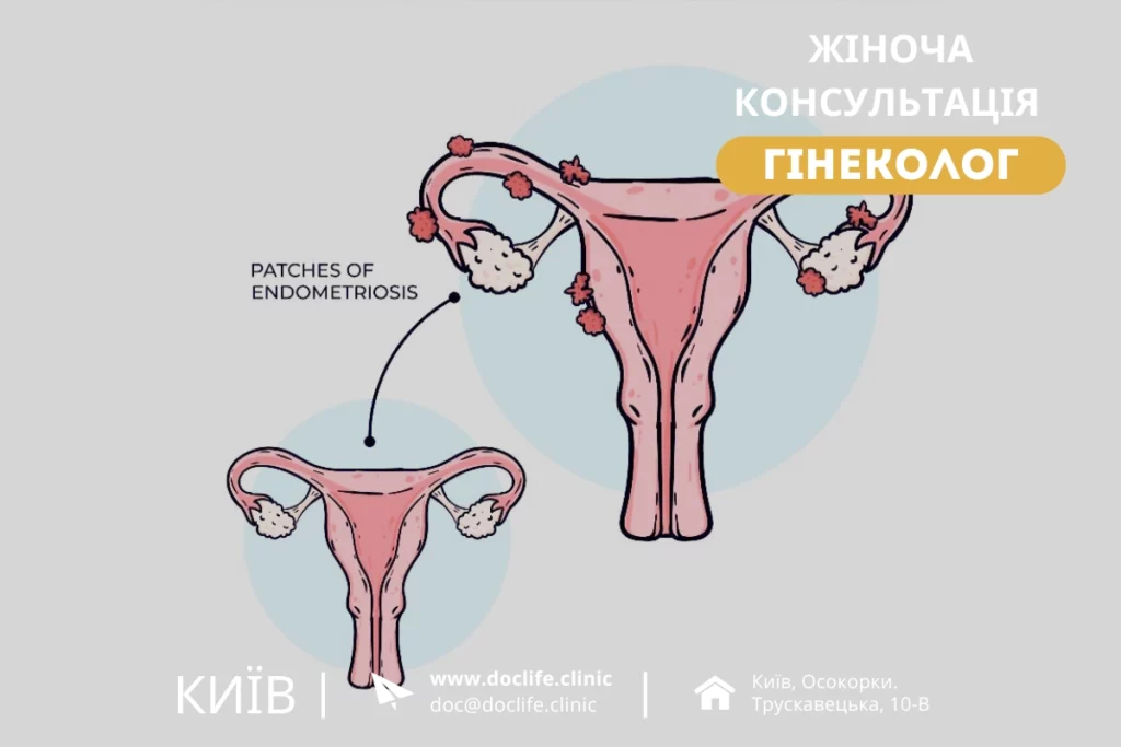 Огляд Та Діагностичні Дослідження Поліп Ендометрію