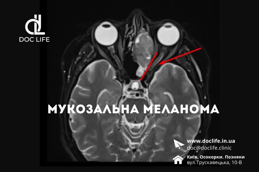 Мукозальна Меланома Київ Клініка Осокорки 1