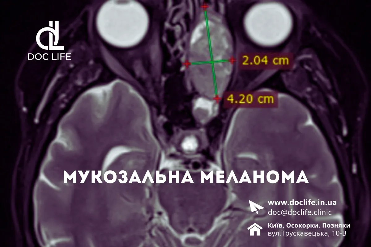 Мукозальна Меланома Київ Клініка Осокорки 2