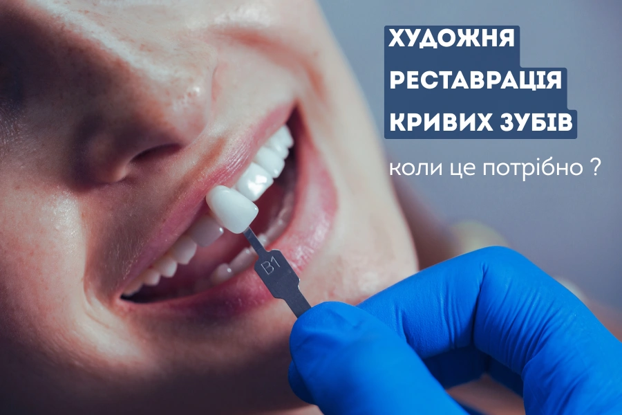 Художня Реставрація Кривих Зубів 4