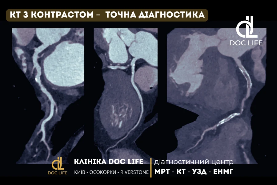 Кт Серця З Контрастом — Зображення Артерій Та Судин У Високій Якості.