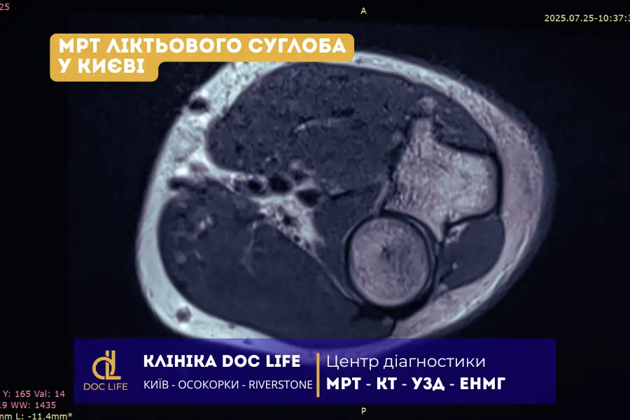 Аксіальний Зріз На Рівні Капсуло-Сухожильного Переходу