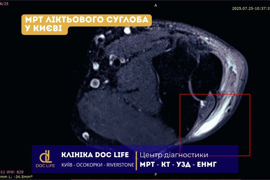 Мрт Ліктьового Суглоба У Києві Аксіальний Т2 Stir: Зона Запалення Чи Набряку М’яких Тканин
