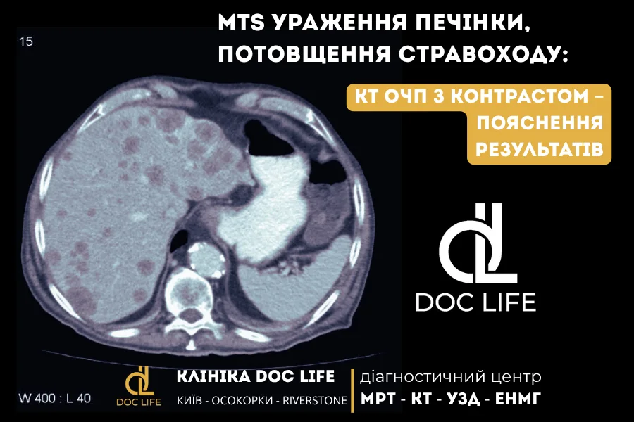Mts Ураження Печінки, Потовщення Стравоходу Кт Очп З Контрастом Пояснення Результатів