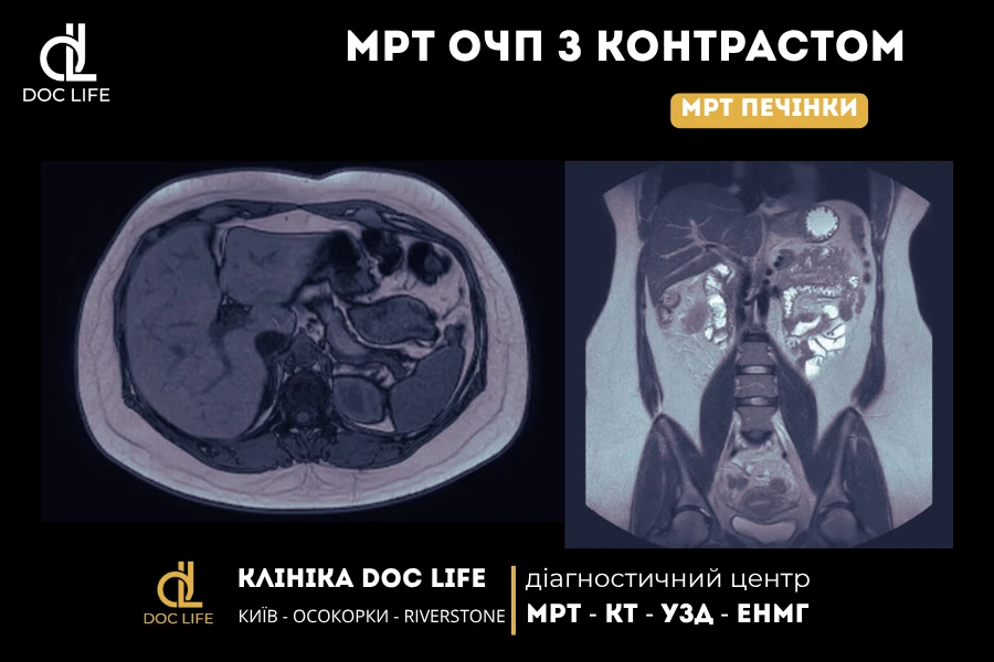 Обмеження Дифузії При Метастазах Печінки На Dwi-Мрт