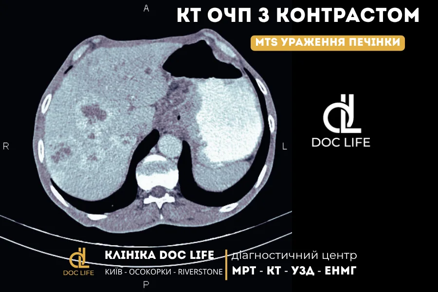 Mts Печінки На Кт З Контрастом У Артеріальній Фазі

