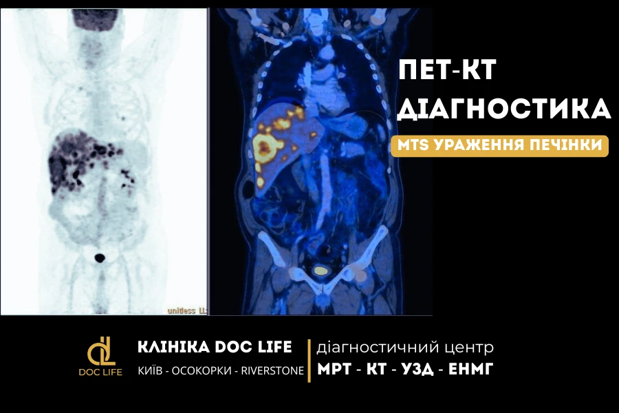 Метастази В Печінці На Пет-Кт З Накопиченням 18F-Фдг

