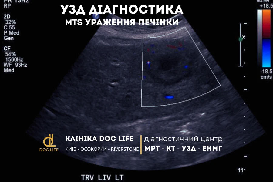 На Узд Видно Кілька Гіпоехогенних Вузлів У Печінці З Нечіткими Контурами. Метод Менш Чутливий, Але Може Використовуватись Для Первинного Виявлення.
